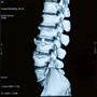 Slipped Disc? Rest Assured, It Hasn’t Slipped Out Of Place! Writes Preston Chiropractor