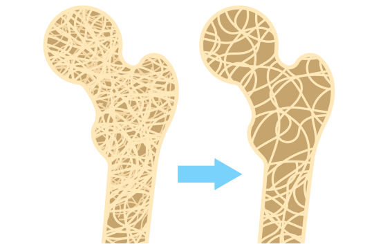 osteoporosis