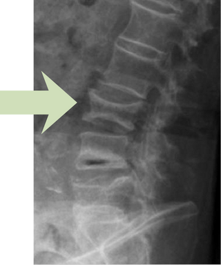 x-ray osteo (528 x 384 px) (400 x 384 px)